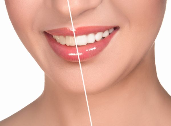 Зубы до и после снятия налета.